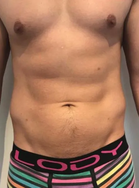 The same front view after TightSculpting, with the abdomen flatter and the underlying contour clearer
