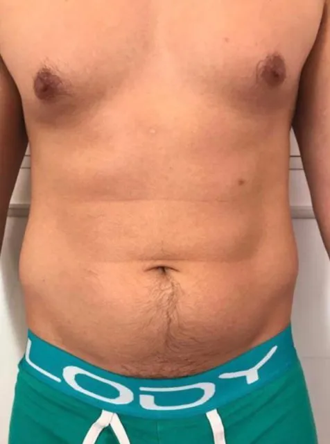 Front view of a man’s torso before TightSculpting, showing softness across the abdomen
