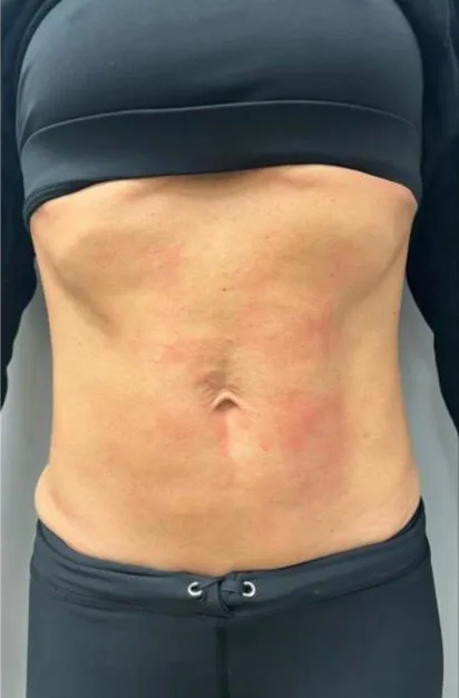 The same front view after TightSculpting, with the skin firmer and the lines much fainter