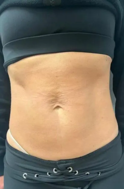 Front view of a woman’s abdomen before TightSculpting, showing loose crepey skin with fine horizontal lines