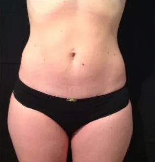 The same front view after TightSculpting, with the waist narrower and the hip line smoother
