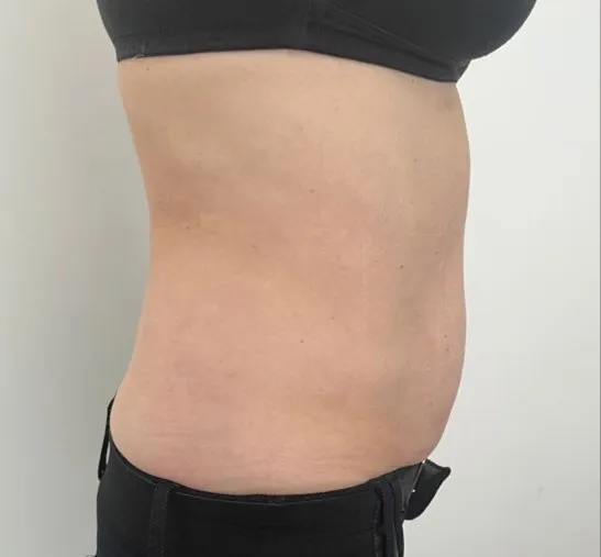 The same side view after TightSculpting, with a flatter profile through the waist
