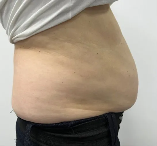 Side view of a woman’s abdomen before TightSculpting, showing fullness carried forward at the waist