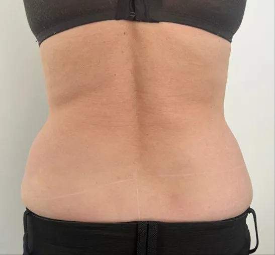The same back view after TightSculpting, with the lower back smoother