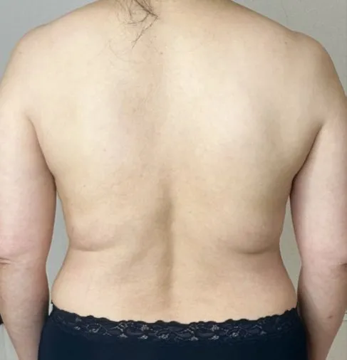 The same back view after TightSculpting, with the back line noticeably smoother