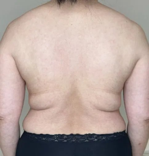 Back view of a woman before TightSculpting, showing rolls at the bra line and along both flanks