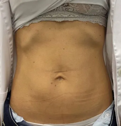 The same overhead view after TightSculpting, with the skin tighter and the lines much reduced