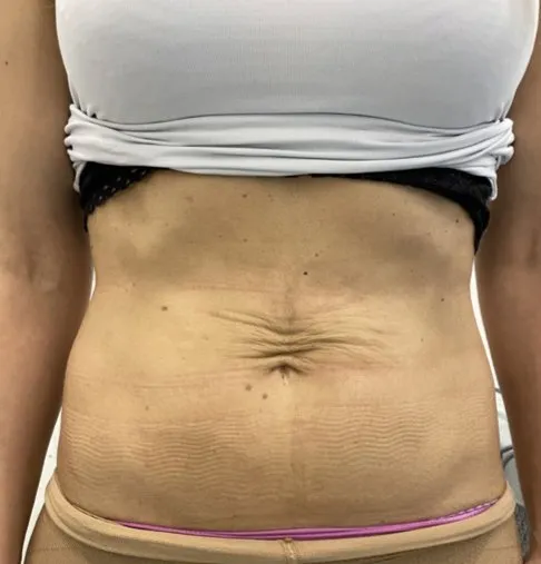 Overhead view of an abdomen before TightSculpting, showing crepey lax skin in fine lines around the navel