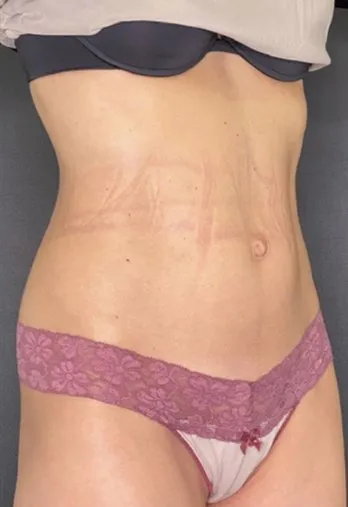 The same three-quarter view after TightSculpting, with the abdomen flatter and the contour visible again