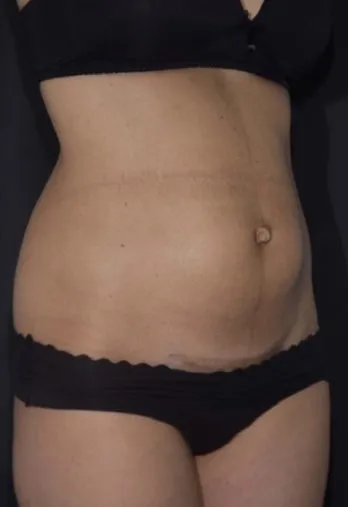 Three-quarter view of a woman’s abdomen before TightSculpting, showing a lower-belly bulge