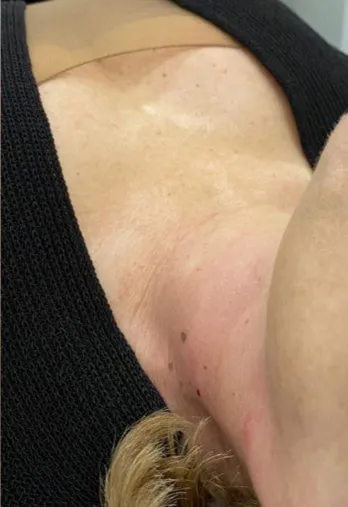 The same close-up after TightSculpting, with the skin visibly tighter