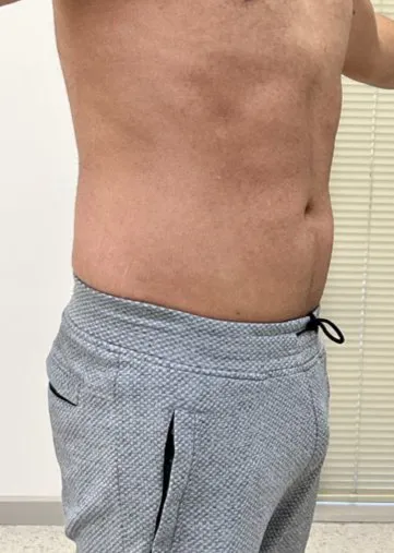 The same side view after TightSculpting, with a flatter line through the waist