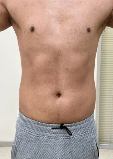 The same front view after TightSculpting, with the abdomen flatter and more defined