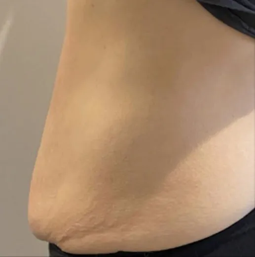 The same side view after TightSculpting, with the hip and flank line smoother