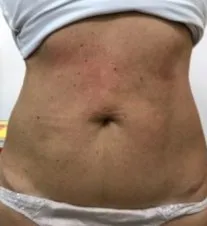 The same close-up after TightSculpting, with the abdomen firmer