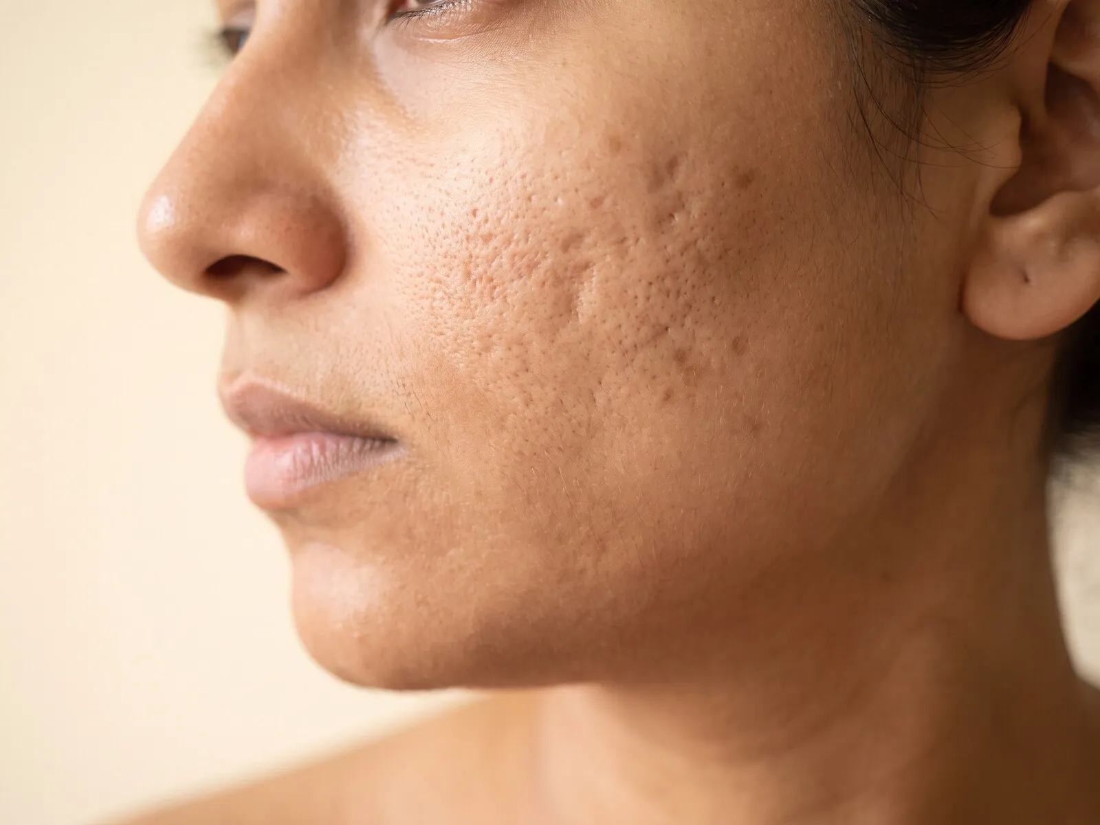 Close-up of a cheek with indented acne scarring and visible texture, the kind of concern microneedling with PRP or PRF is used for