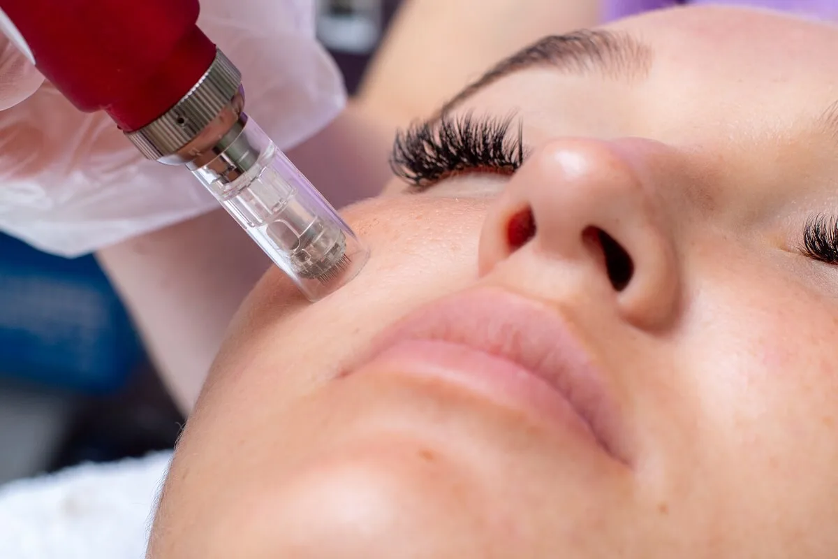 SkinPen microneedling device being drawn across a patient's cheek during collagen induction therapy at Medrein Health in Southlake, TX