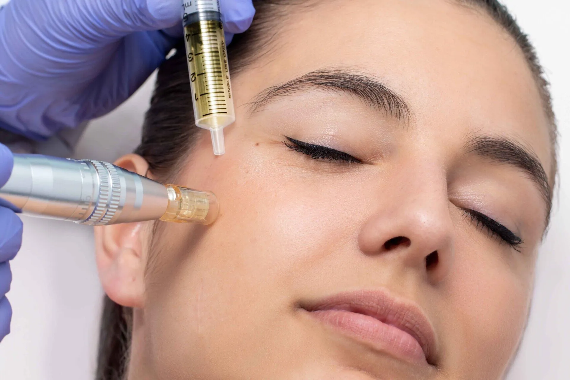 A microneedling handpiece being drawn across a patient’s cheek during an aesthetics treatment