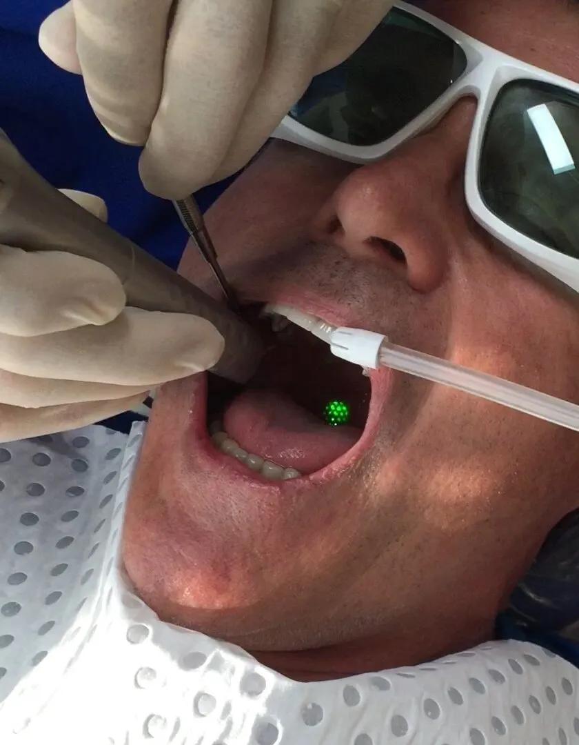 A Fotona Er:YAG laser handpiece delivering an intraoral NightLase pass over the soft palate of a patient wearing laser eyewear at Medrein Health