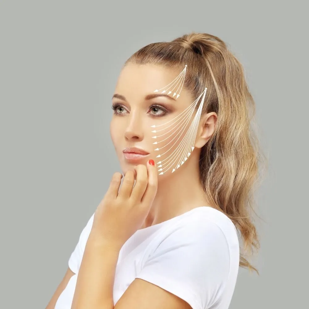 Medrein's illustration of thread lift direction: upward arrows drawn in white over a woman's cheek and temple, showing the line along which lifting threads pull