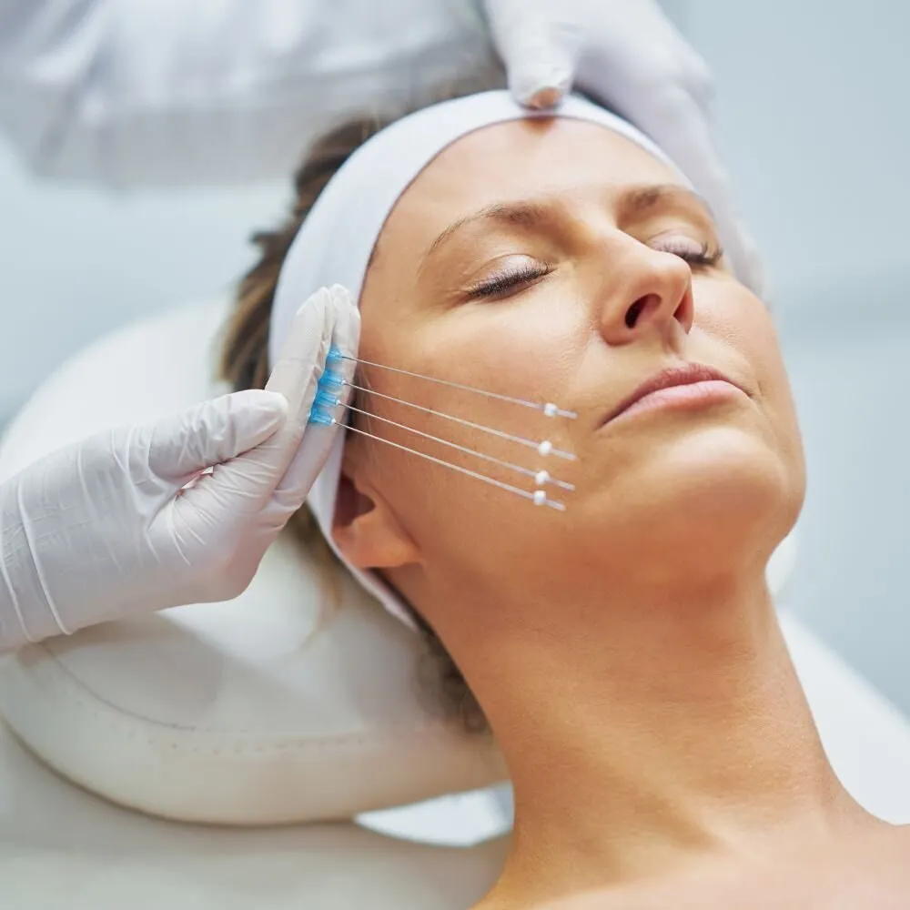 A clinician in white gloves holding four fine PDO threads fanned against a patient's cheek, the patient lying back with her eyes closed