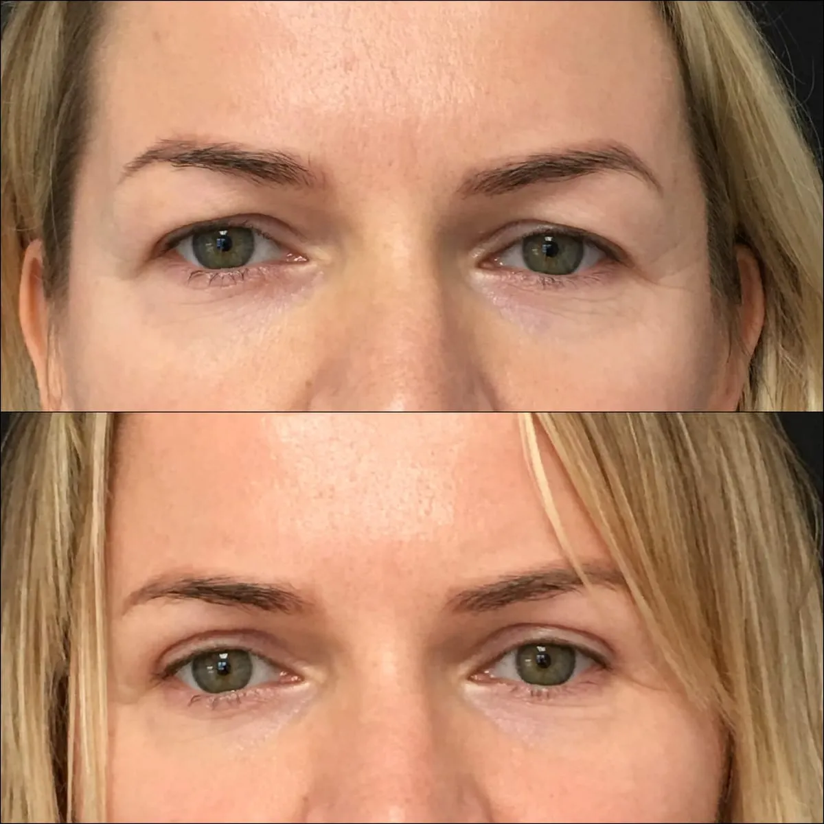 hooded eyes treatment