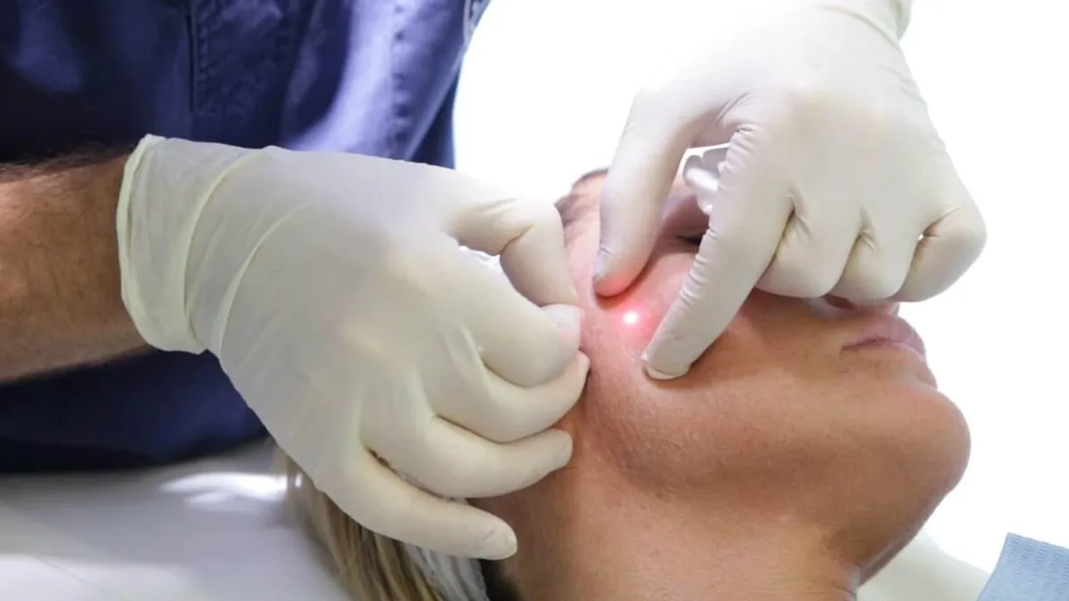 endolift procedure
